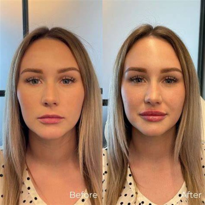 Jennifer Coolidge Botox And Lip Filler Before And After Photos, Beauty Secret Explored!